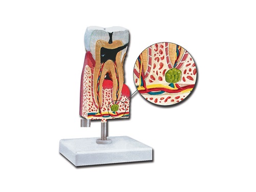 Model of Lower Molar With Caries